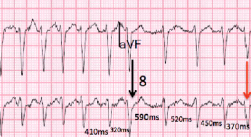 Atrial Fibrillation (AFib) Can Happen to Anyone.