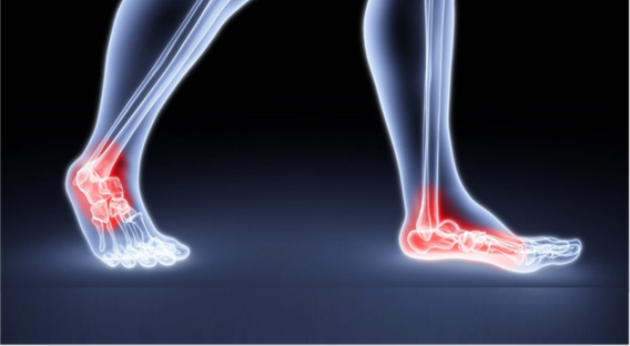 Is Your Heel Pain a Sore Foot or Plantar Fasciitis?